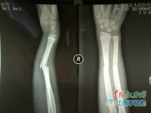 龙南一男童不慎跌致骨折蓝飞中医敷药治愈
