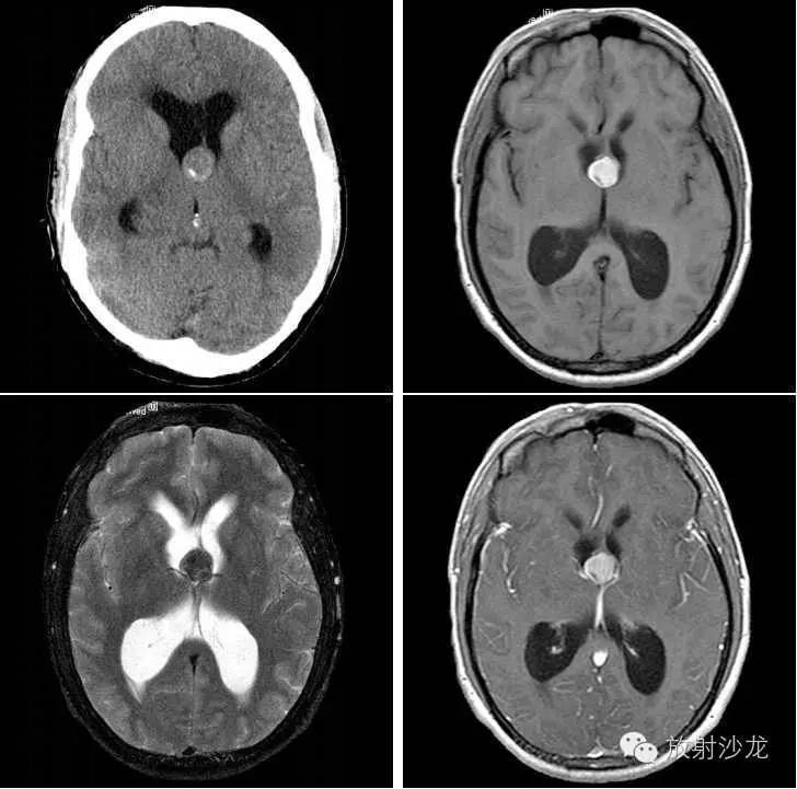 囊肿病例报告,囊肿病例