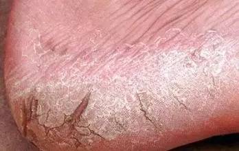 冬天皮肤病高发怎么办,冬季四种皮肤病须谨防快自测一下