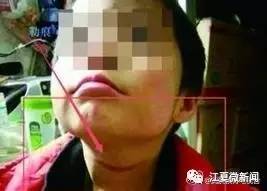 七岁女孩近视散光,9岁女童近视散光