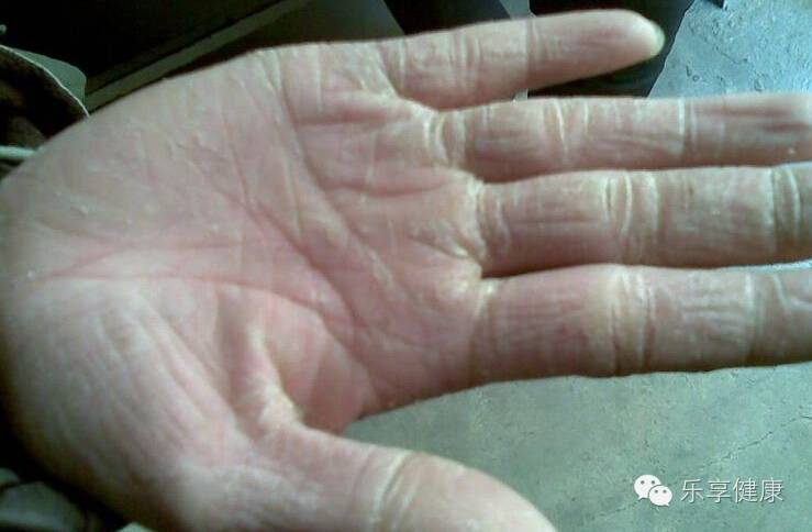 冬天手足皲裂涂什么药膏,冬季手部皲裂严重用什么药