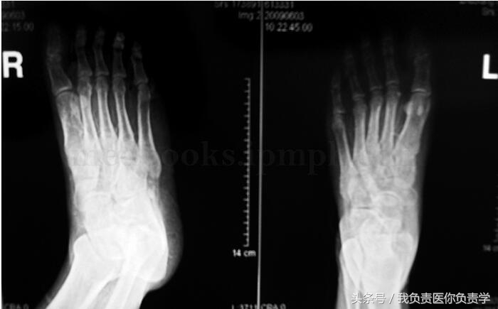 肾移植后坏死能活多久,肾移植后常见的感染部位有哪些