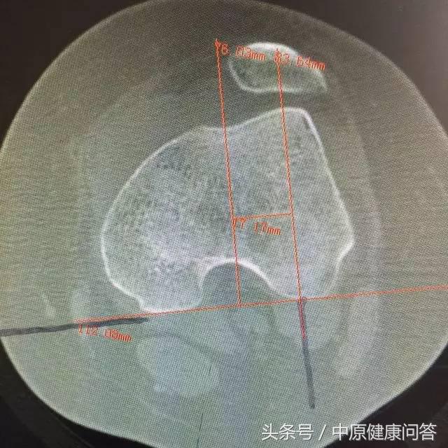 先天性习惯性流产,习惯性流产后期有可能会好吗