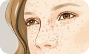 脸上长色斑怎么解决,毛孔粗大色斑多怎么解决