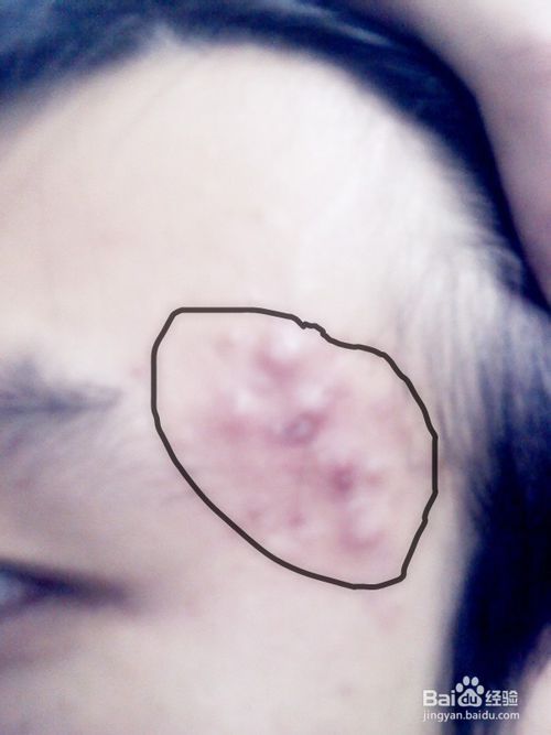 怎样消除青春痘和粉刺最快的方式,如何有效祛除青春痘