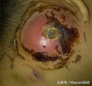 乳腺结节不治是什么结果,猫咪乳腺增生不治会怎么样