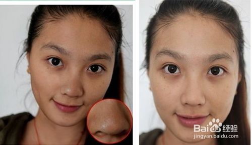 青少年青春痘的治疗小偏方,怎么抗痘痘最有效的方法