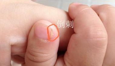 冬季干燥，如何对付指甲倒刺、干燥和脱皮