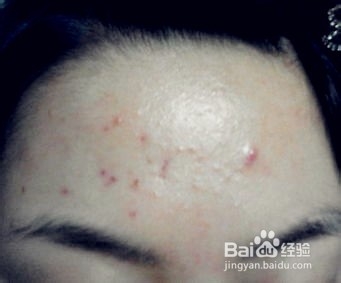 怎样消除青春痘和粉刺最快的方式,如何有效祛除青春痘