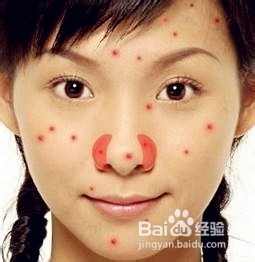 怎样消除青春痘和粉刺最快的方式,如何有效祛除青春痘