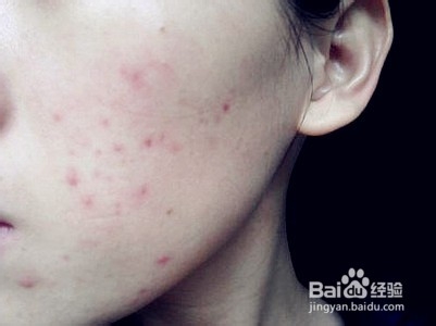 怎样消除青春痘和粉刺最快的方式,如何有效祛除青春痘