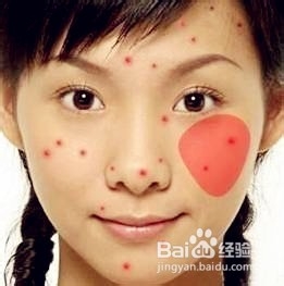 怎样消除青春痘和粉刺最快的方式,如何有效祛除青春痘