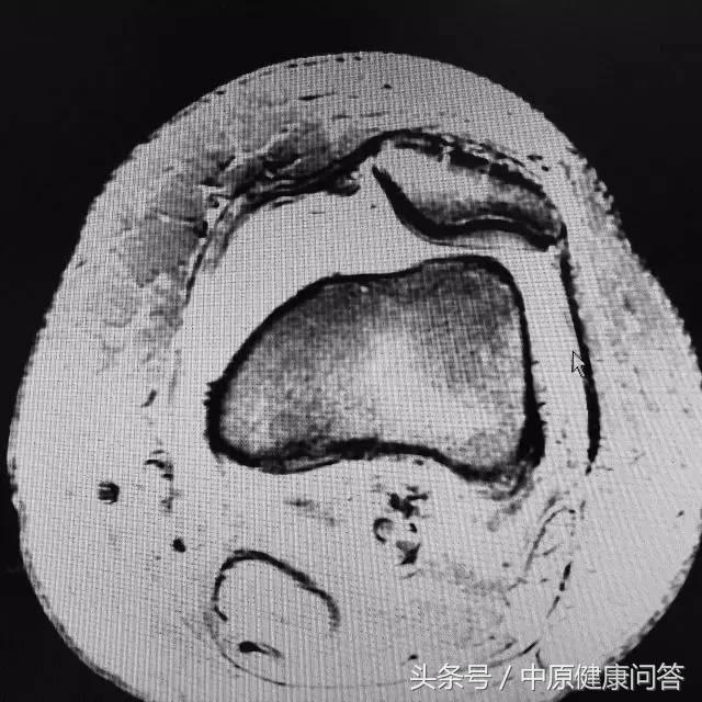 先天性习惯性流产,习惯性流产后期有可能会好吗