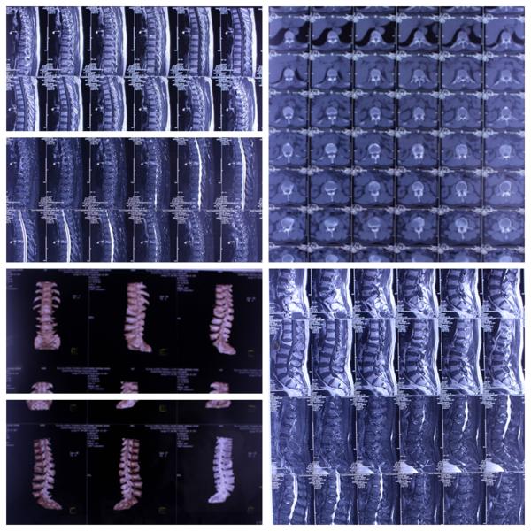 陈旧胸椎压缩性骨折治好的案例,年轻人胸椎压缩性骨折的康复患者