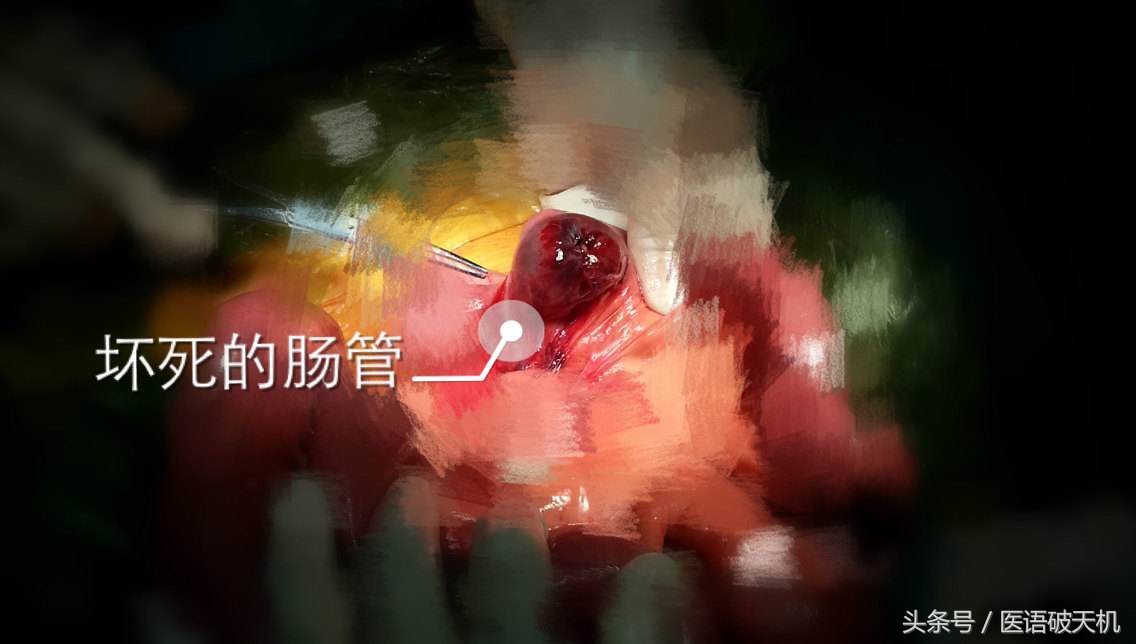 八旬老太切断肠，罪魁祸首竟是知名小吃