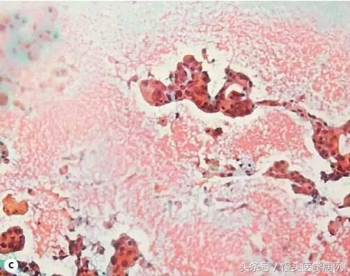 卵巢肿瘤穿刺活检结果,卵巢囊肿穿刺从哪穿刺