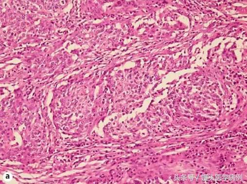 卵巢肿瘤穿刺活检结果,卵巢囊肿穿刺从哪穿刺