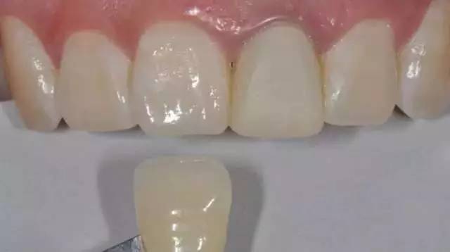 终于知道牙医为什么要拍片,二氧化锆全瓷牙的优缺点