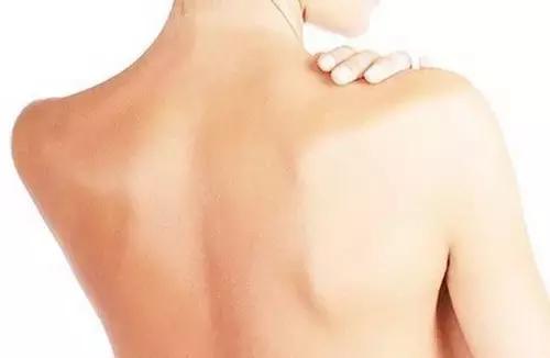 背部长痘痘快速消除方法,后背都是痘痘如何快速祛痘