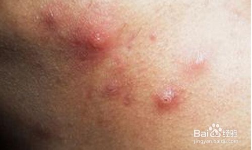 怎样消除青春痘和粉刺最快的方式,如何有效祛除青春痘
