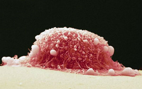 尖锐性湿疣中医辨证,尖锐性湿疣中医辨证治疗