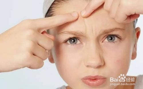 青少年青春痘的治疗小偏方,怎么抗痘痘最有效的方法