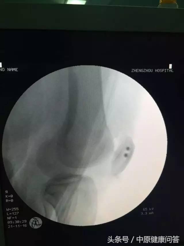 先天性习惯性流产,习惯性流产后期有可能会好吗