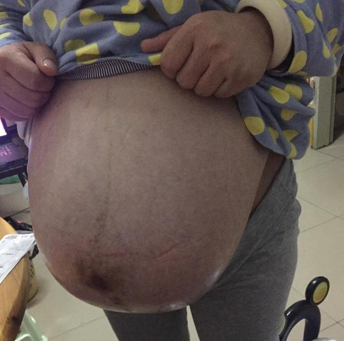 孕38周+2天超快顺产女宝一枚,(无侧切)附上四维和数据症状