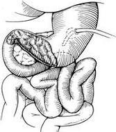 胃肠间质瘤到底是什么,胃肠间质瘤中医能治愈吗