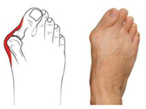 拇外翻患者需知有几种治疗方法