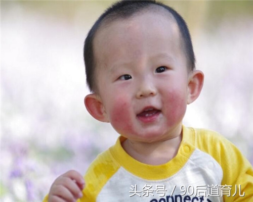 宝宝高原红的脸用什么修复,宝宝一到秋冬季就大红脸