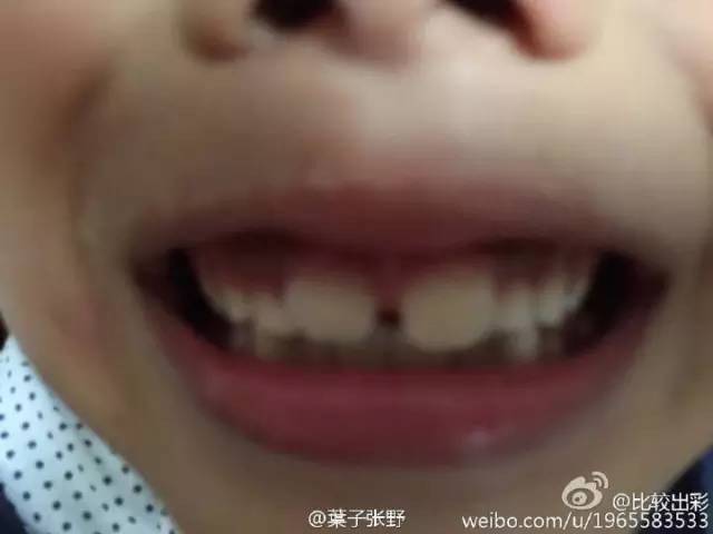 小孩牙齿不齐换牙后会变好吗,为什么换牙后牙齿不齐