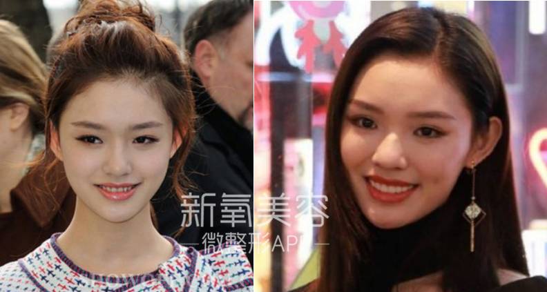 林允整牙却像整容?她是真的又整了啊!