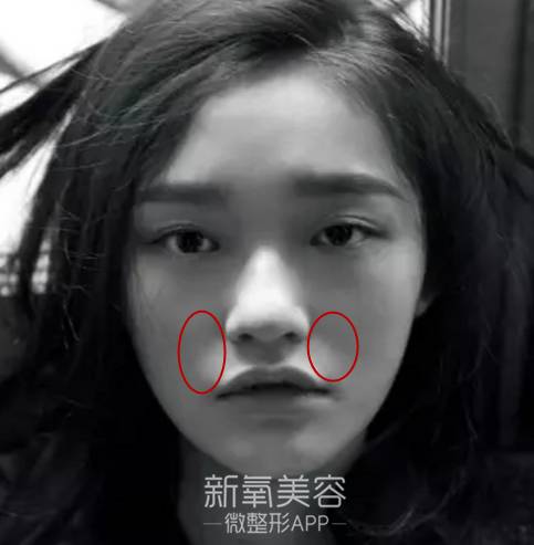 林允整牙却像整容?她是真的又整了啊!