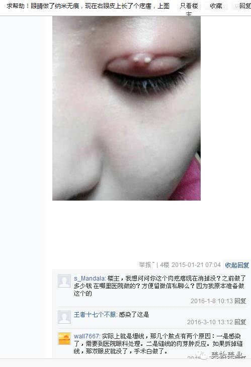 日本纳米无痕双眼皮加开眼角,纳米无痕双眼皮15天恢复图