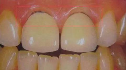 终于知道牙医为什么要拍片,二氧化锆全瓷牙的优缺点