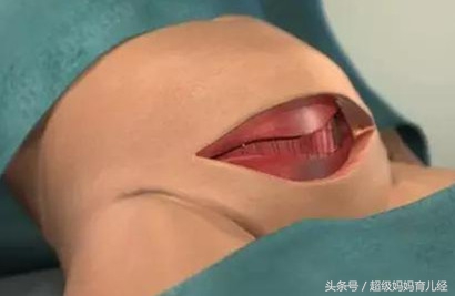 生娃顺产好还是剖腹产,生孩子是选择顺产好还是剖腹产好