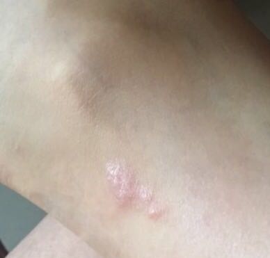 推荐便宜好用的祛疤膏,你有什么祛疤膏推荐吗