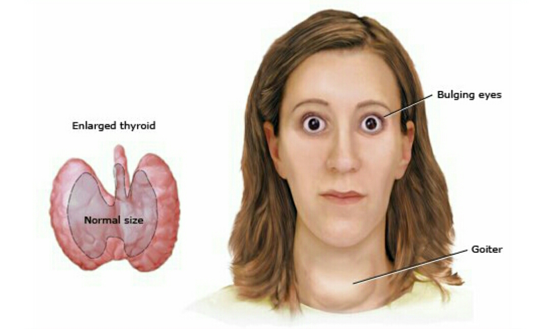 妊娠期甲亢患者治疗选用,妊娠期甲亢对孕妇的影响