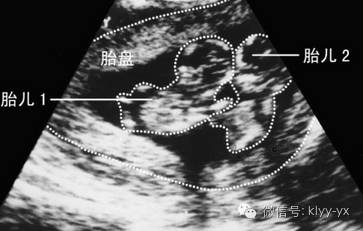 「分娩前后」头胎剖二胎想顺?看看您符合条件吗?