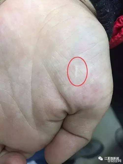 七岁女孩近视散光,9岁女童近视散光