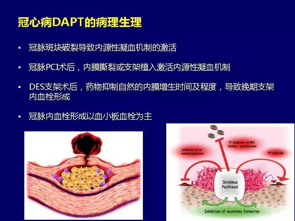 许锋︱冠心病双联抗血小板治疗