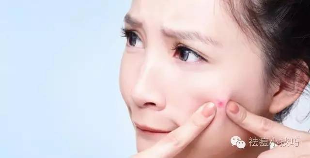 脸上各个部位长痘原因一张图,脸颊长痘物理消痘法