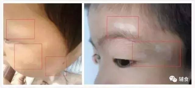 宝宝脸上白斑是真菌感染吗,怎么区分孩子脸上虫斑与白癜风