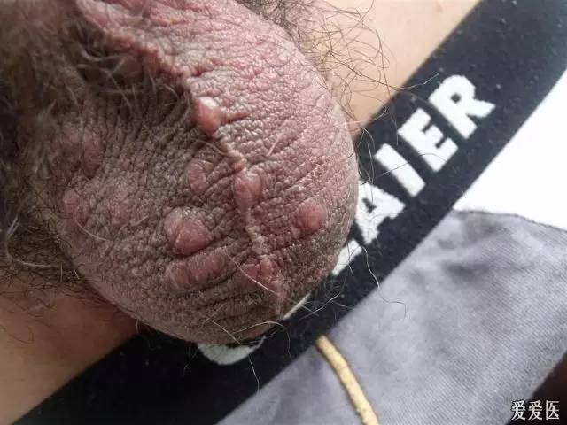 GET这14条，你就可以和疥疮拜拜了