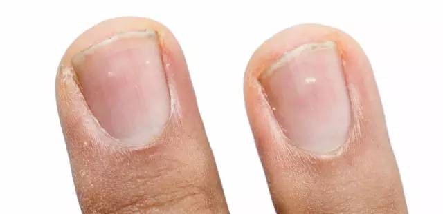 指甲里有白点是有蛔虫么,儿童指甲有白点蛔虫