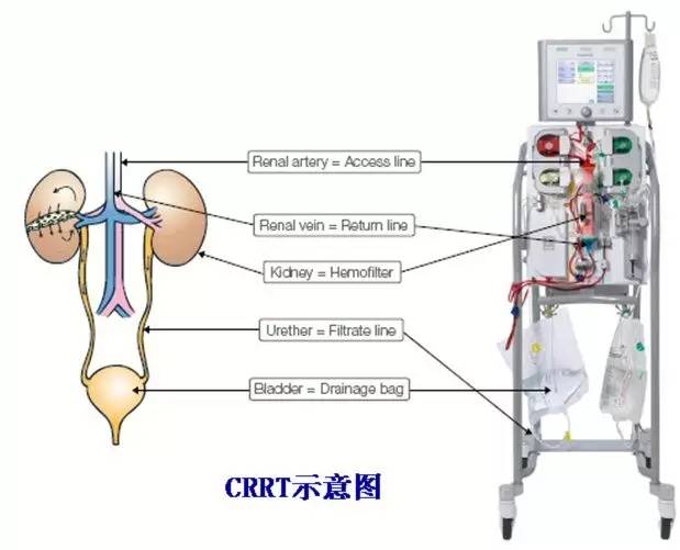 连续性血液净化设备,连续性血液净化技术操作视频