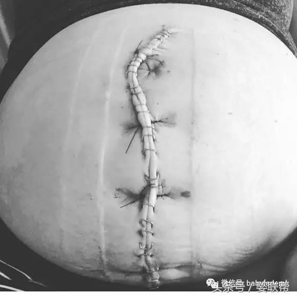 先别被图片吓到,这位剖腹产妈妈的自白让无数人感动