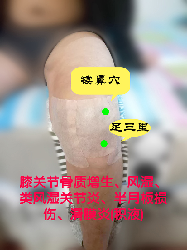 半月板的知识大全,半月板如何治疗才能恢复如初