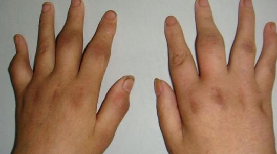 小孩有关节炎怎么办啊,孩子得了类风湿家长该怎么办